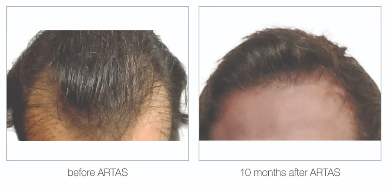 Nashville hair transplant