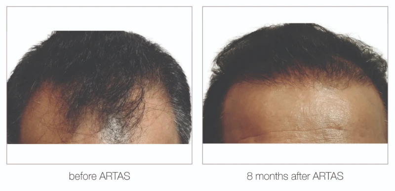 Nashville hair transplant