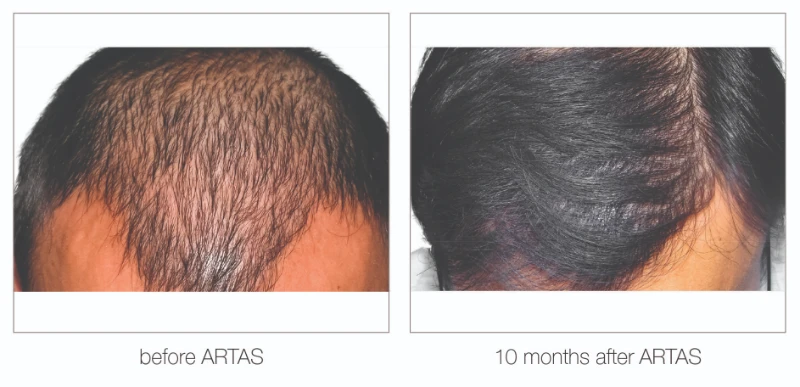 Nashville hair restoration