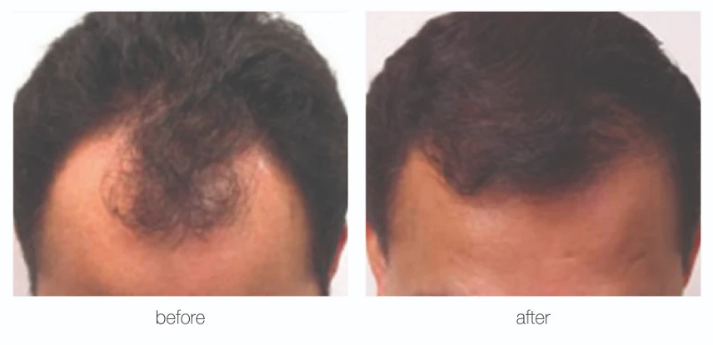 Nashville hair restoration