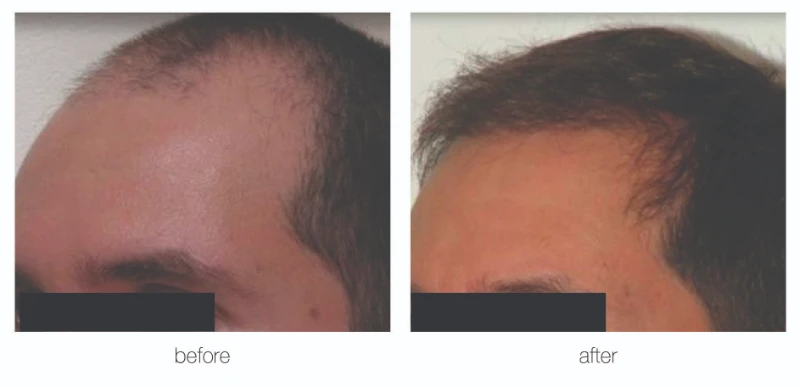 Nashville hair transplant