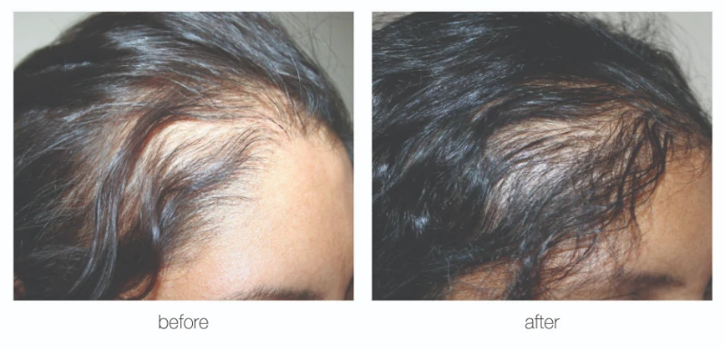 Nashville hair transplant