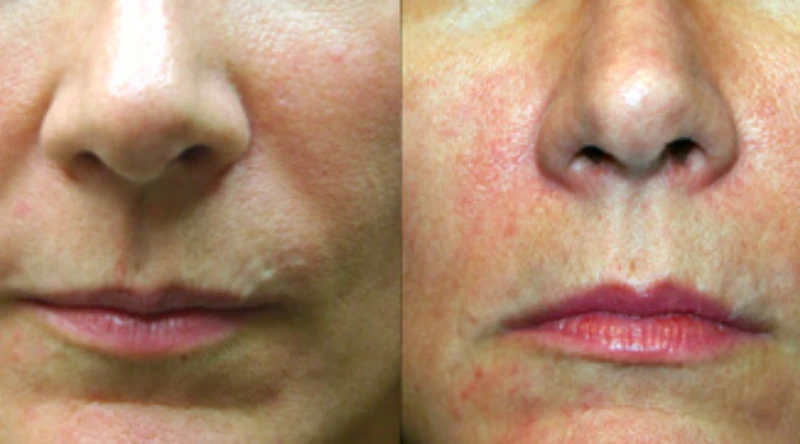 Nashville laser skin resurfacing